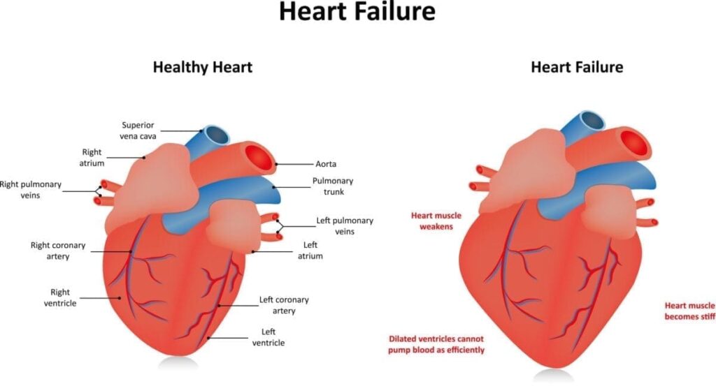 What is Heart Failure?
