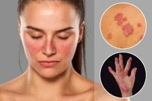 Lupus symptoms